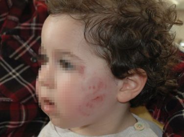 Kreşte 1,5 Yaşındaki Bebeğin Dövüldüğü İddiası